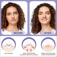 30 Pcs Pimple Patches