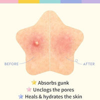 30 Pcs Pimple Patches